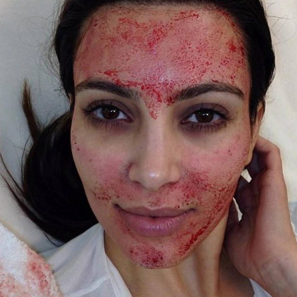 Vampire Facial Kim Kardashian