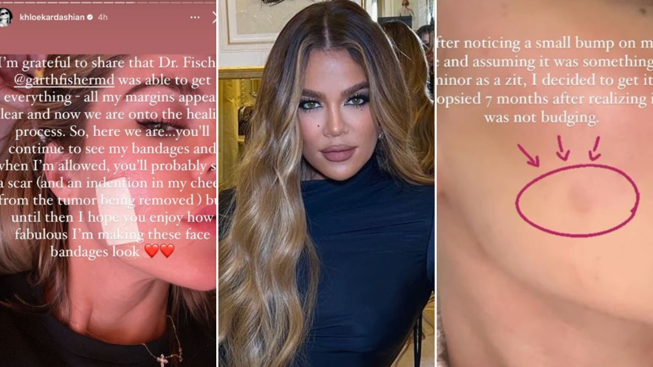 overflade kærtegn Hellere Khloé Kardashian reveals skin cancer scare, has tumour removed from her  face – Emirates Woman
